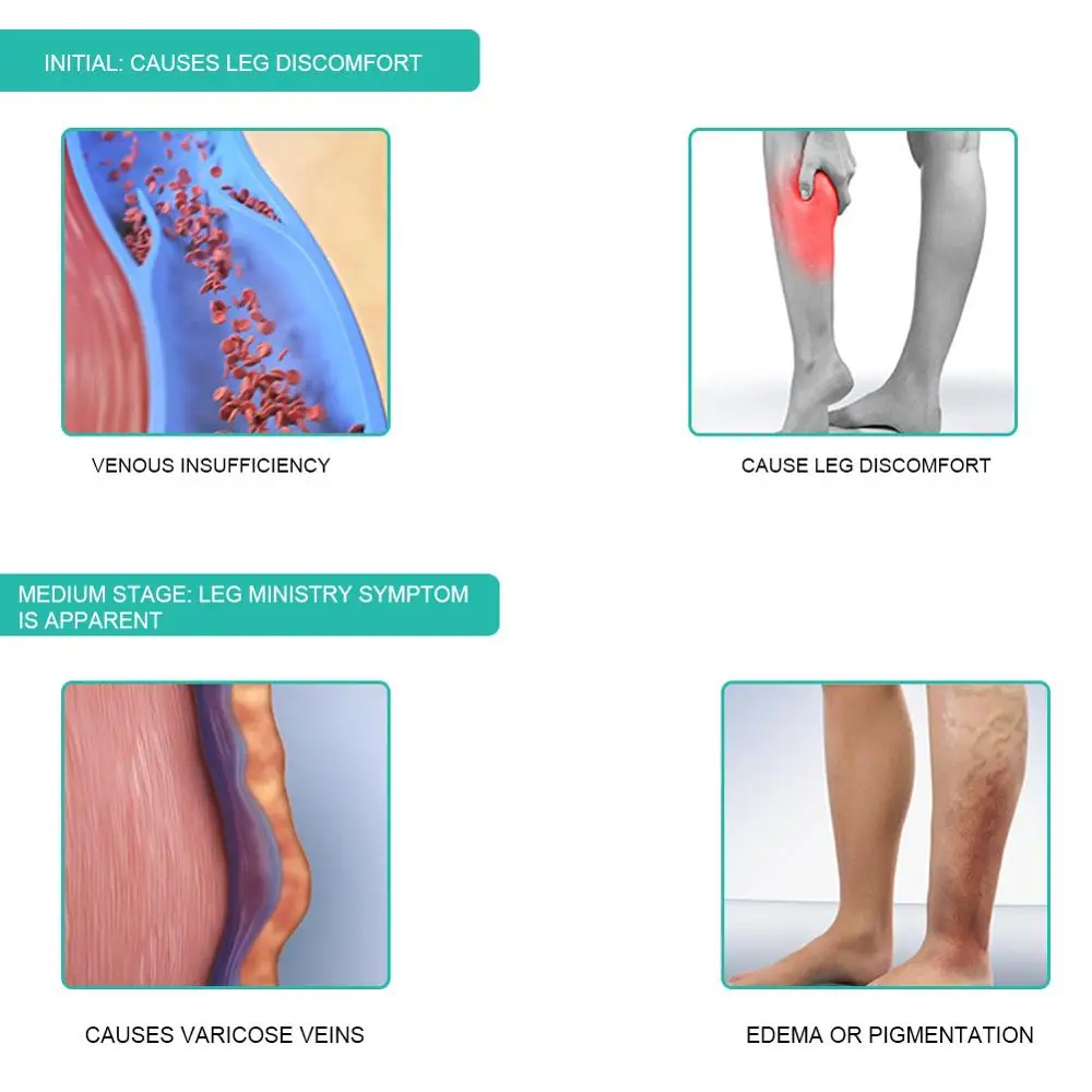 1 Pasang Medis Kompresi Kaus K - Compression Calf Sleeve ulasan dan harga